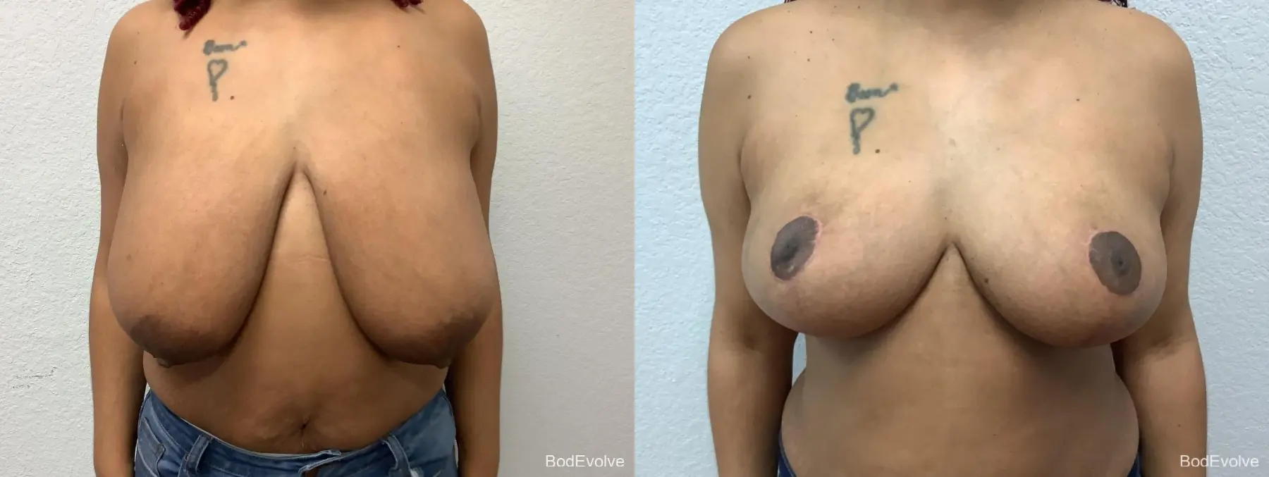 Breast Reduction: Patient 3 - Before and After  