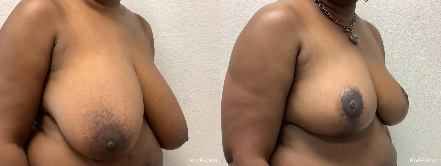 Breast Reduction: Patient 5 - Before and After 4