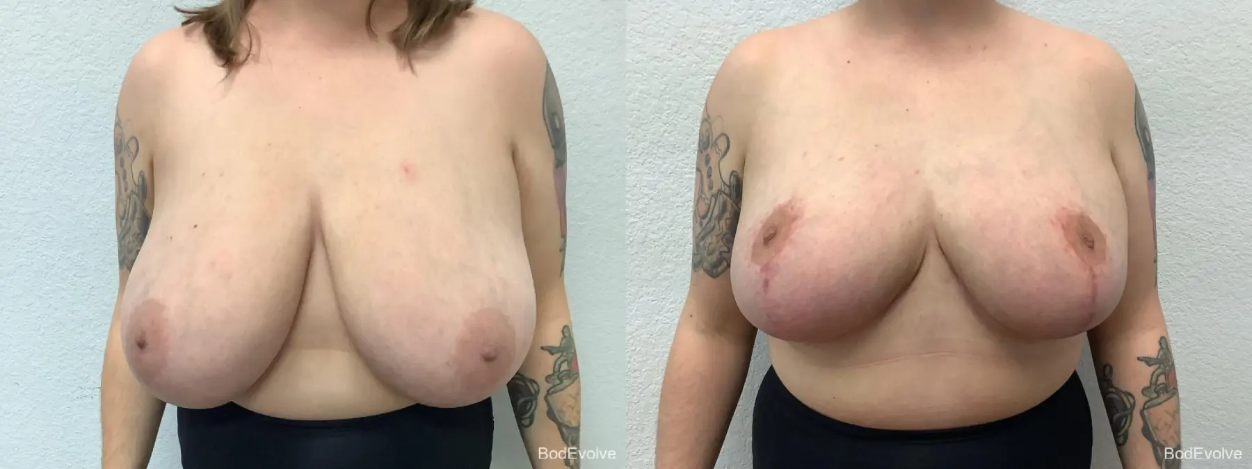 Breast Reduction: Patient 6 - Before and After  