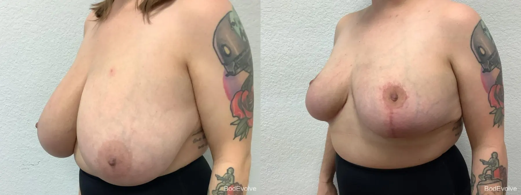 Breast Reduction: Patient 6 - Before and After 2