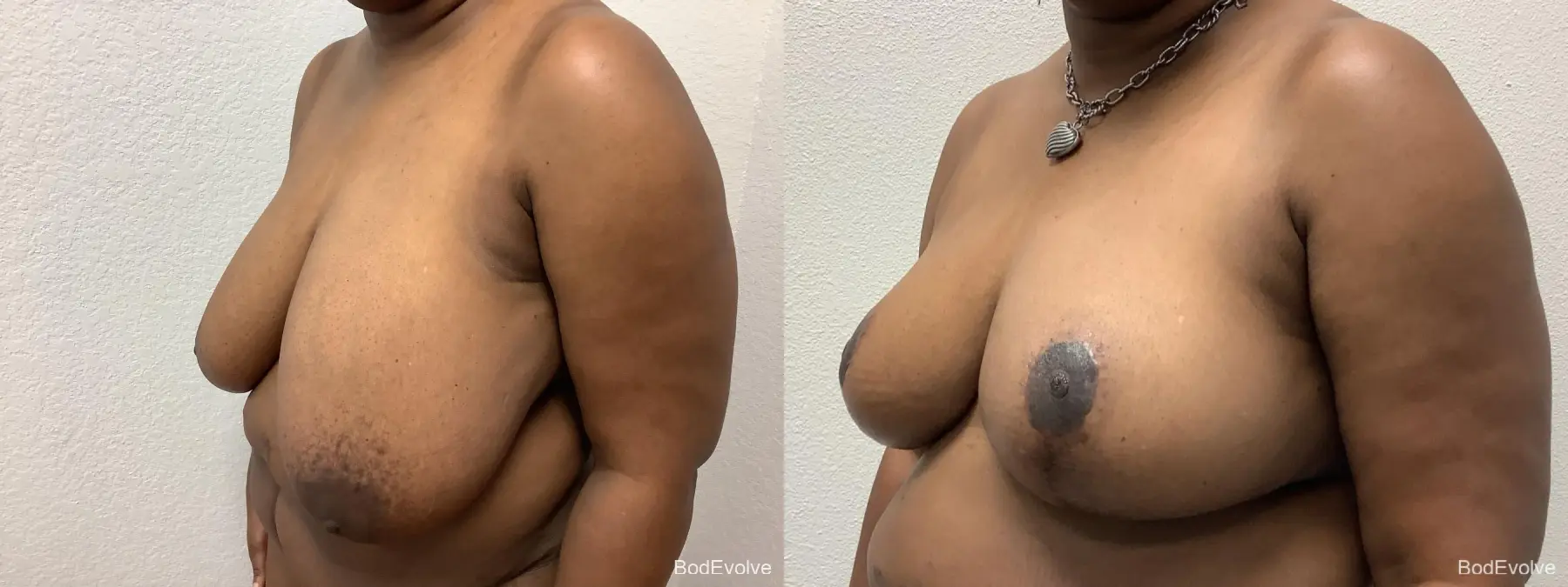 Breast Reduction: Patient 5 - Before and After 2