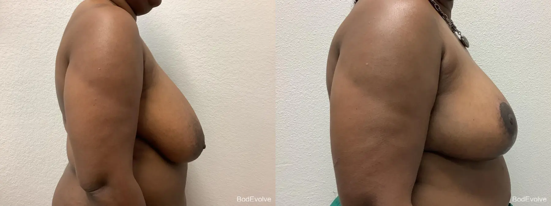 Breast Reduction: Patient 5 - Before and After 5