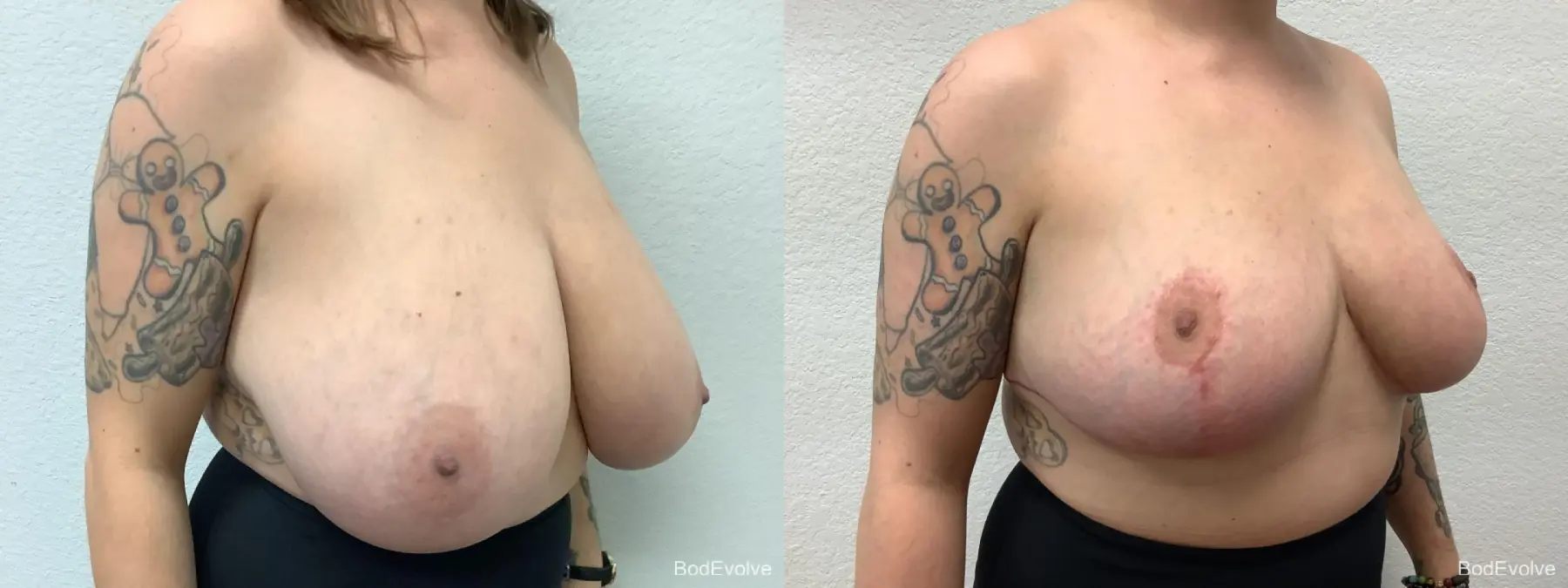 Breast Reduction: Patient 6 - Before and After 5