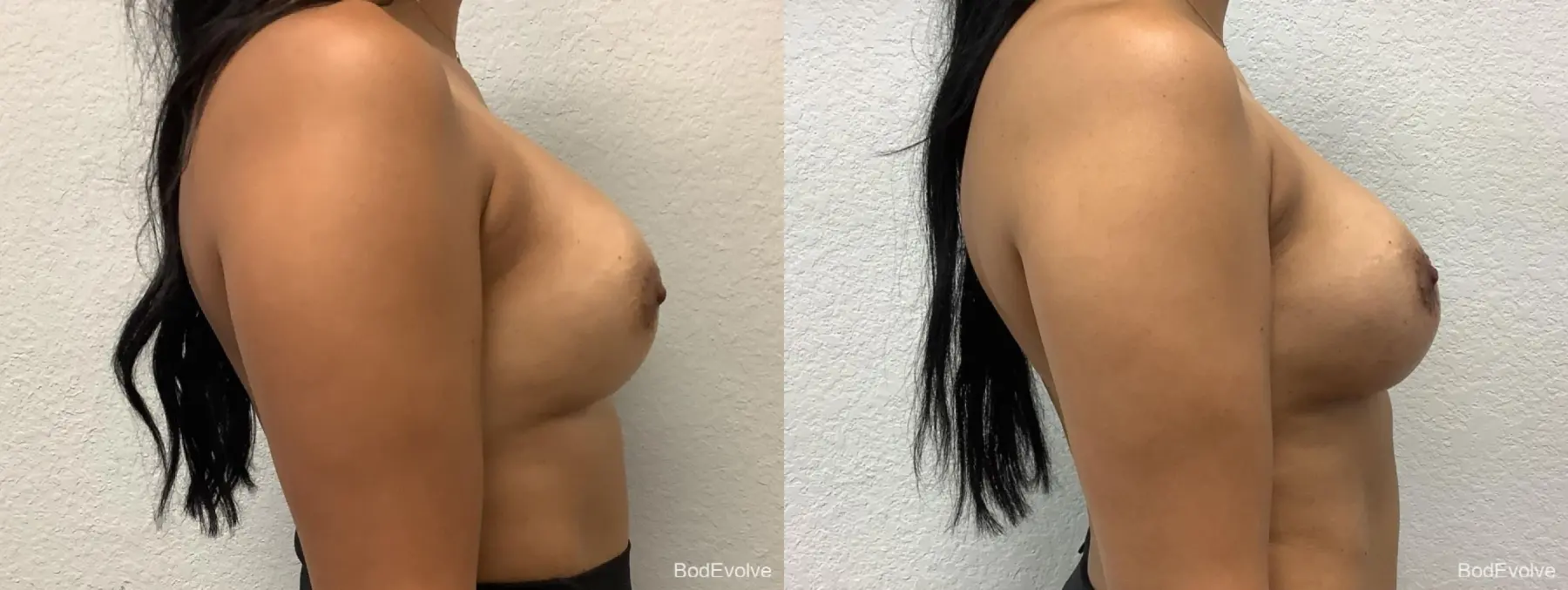 Breast Revision: Patient 2 - Before and After 5