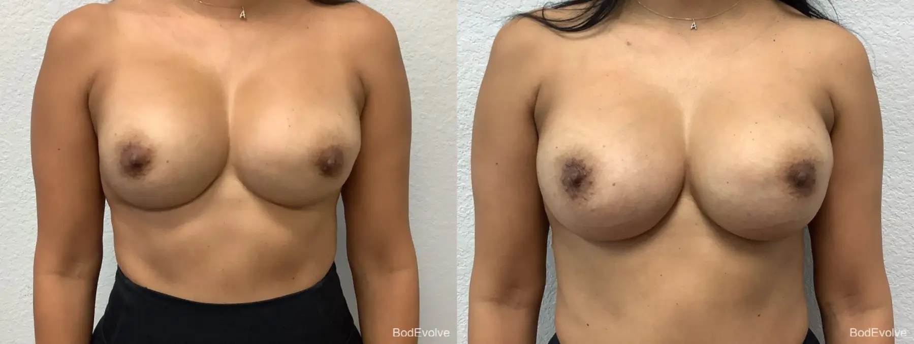 Breast Revision: Patient 4 - Before and After  