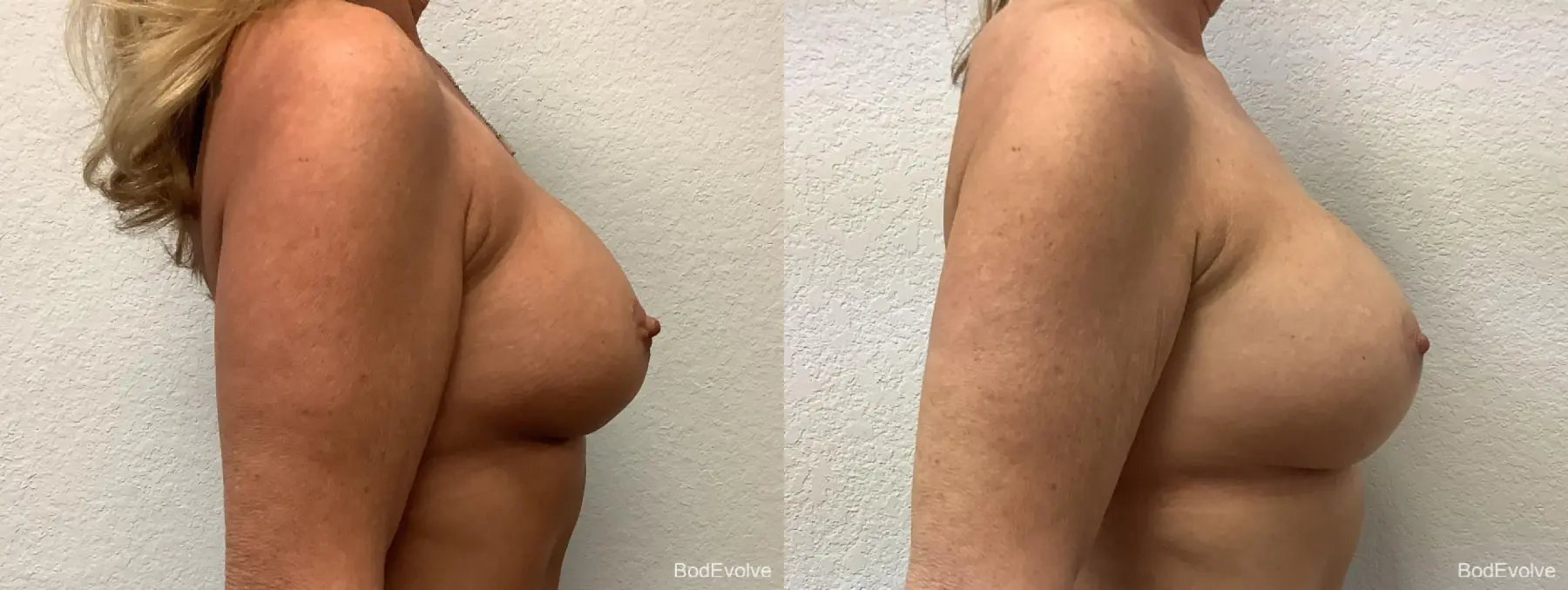 Breast Revision: Patient 1 - Before and After 5