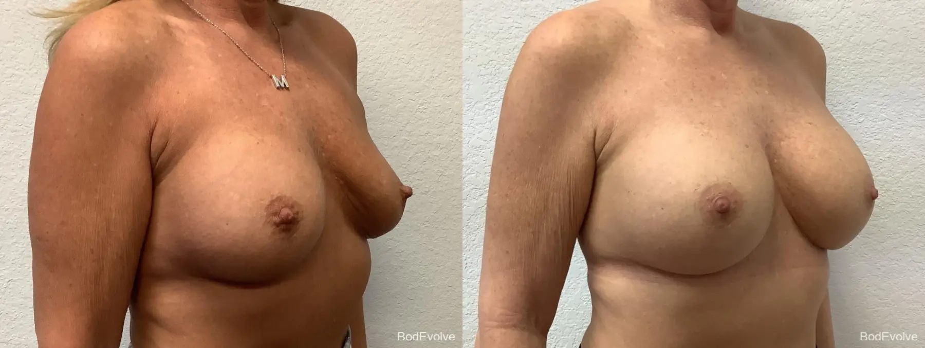 Breast Revision: Patient 1 - Before and After 4