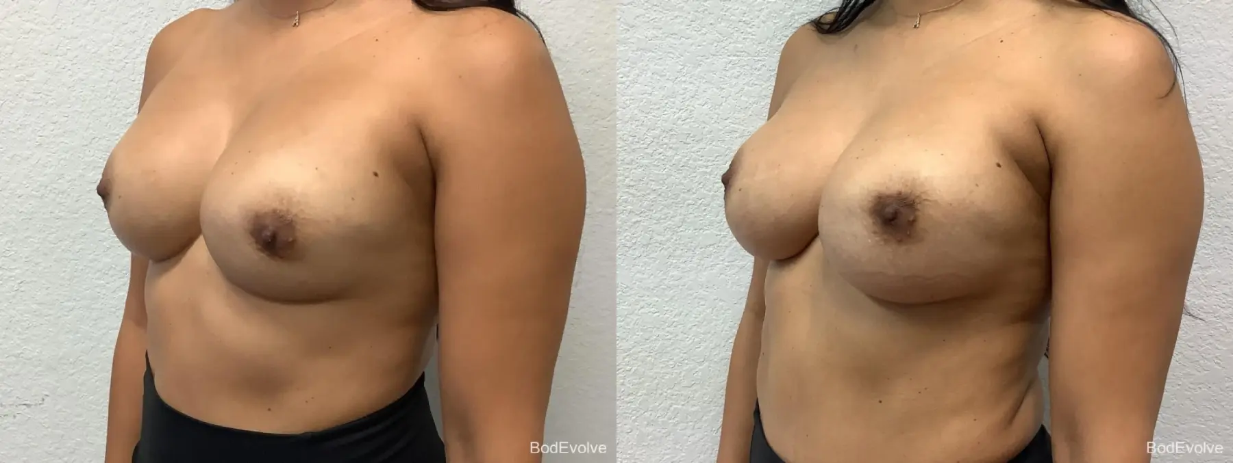 Breast Revision: Patient 2 - Before and After 2