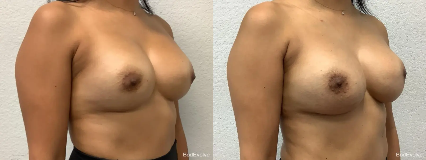Breast Revision: Patient 2 - Before and After 4