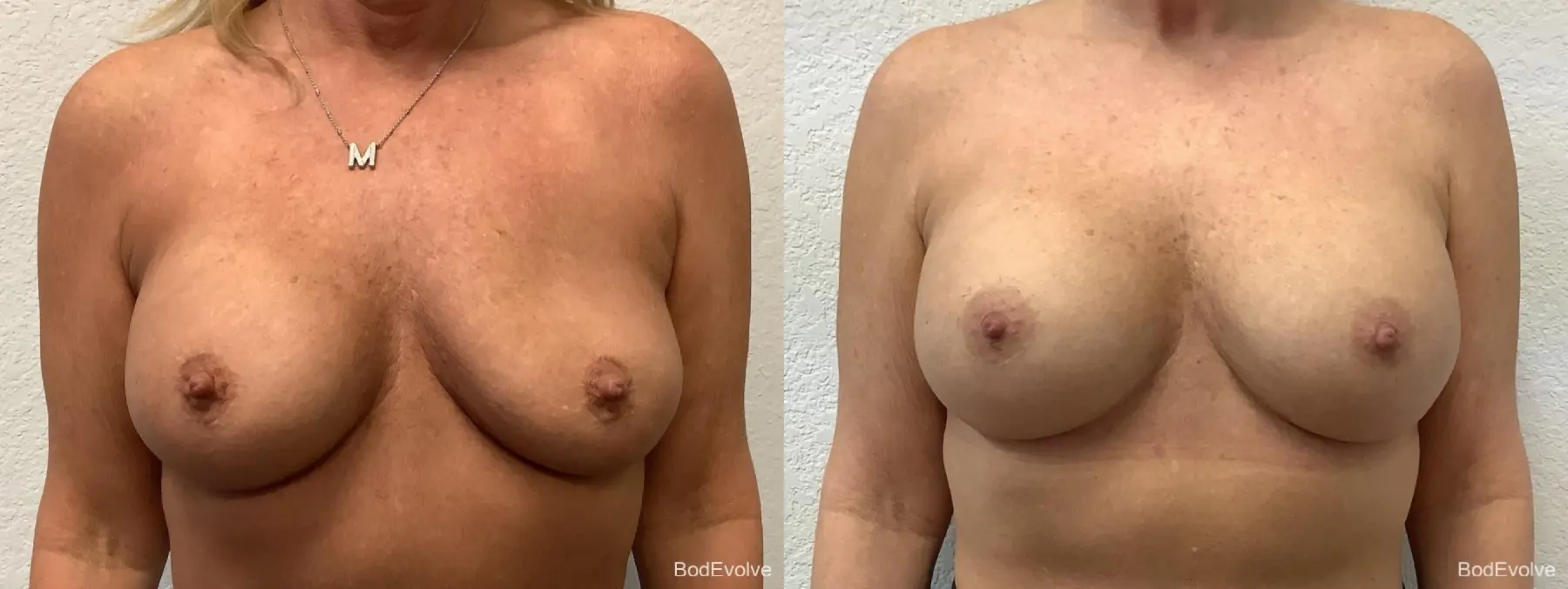 Breast Revision: Patient 2 - Before and After  
