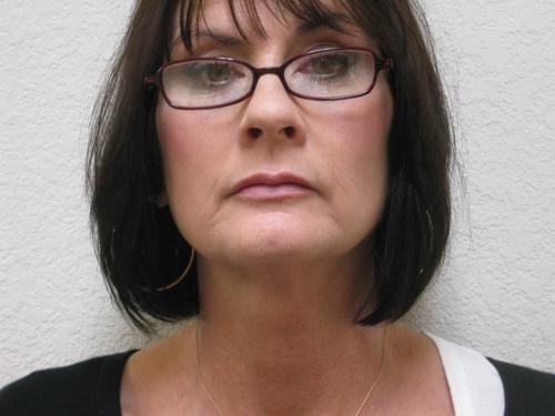 Lip Augmentation - Patient 2 - After 