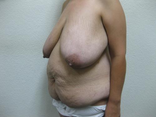 Patient 12 - Cosmetic Surgery After Massive Weight Loss - Before 2
