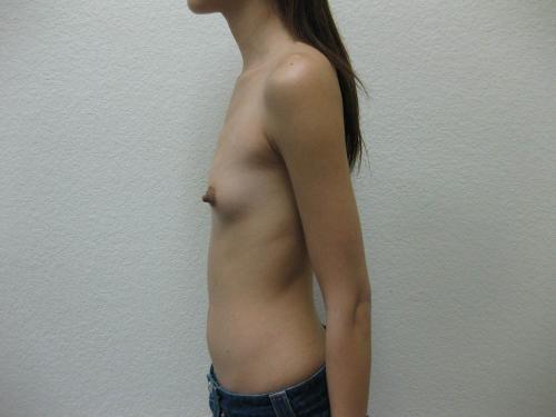 Breast Augmentation - Patient 22 - Before and After 3