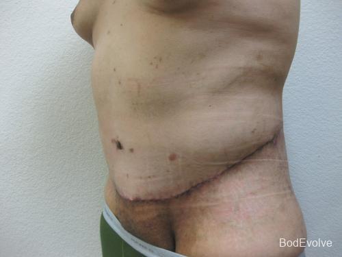 Patient 3 - Cosmetic Surgery After Massive Weight Loss -  After 2