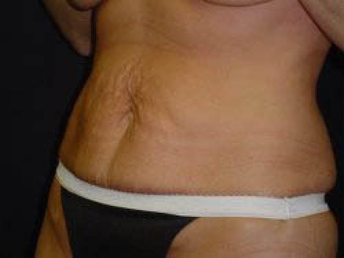 Tummy Tuck - Patient 7 - Before 2