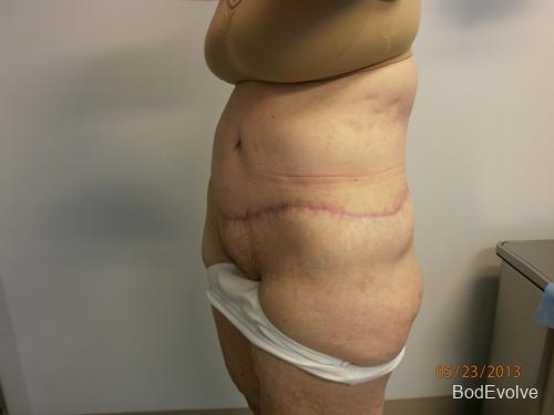 Patient 7 - Cosmetic Surgery After Massive Weight Loss -  After 2