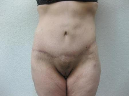 Body Lift - Patient 8 - After Image 6