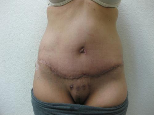 Patient 25 - Cosmetic Surgery After Massive Weight Loss -  After 1