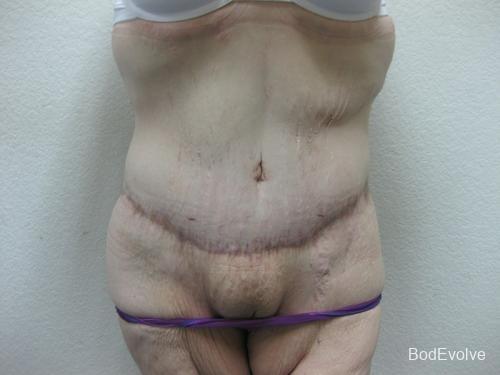 Patient 6 - Cosmetic Surgery After Massive Weight Loss -  After 1