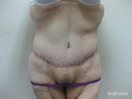 Patient 6 - Cosmetic Surgery After Massive Weight Loss - After 