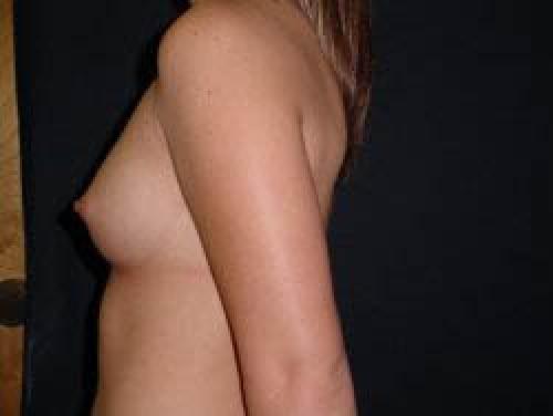 Breast Augmentation - Patient 11 - Before and After 3