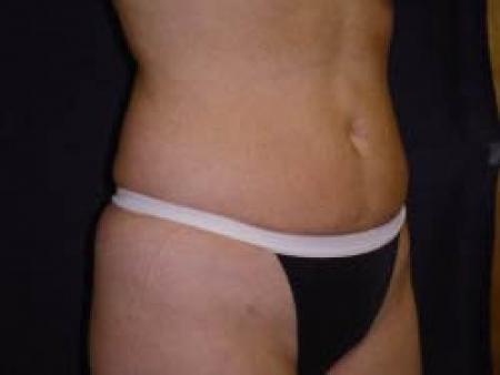 Liposuction - Patient 8 - After Image 4
