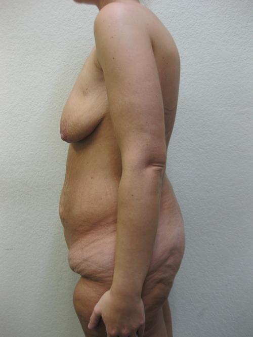 Cosmetic Surgery After Massive Weight Loss - Before 3