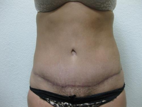 Tummy Tuck - Patient 4 -  After 1