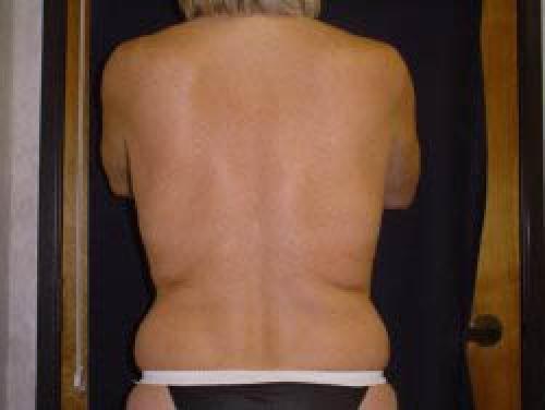Liposuction - Patient 8 -  After 2