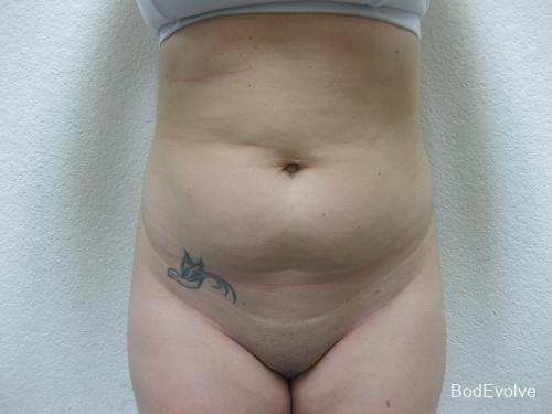 Liposuction - Patient 2 - Before 1