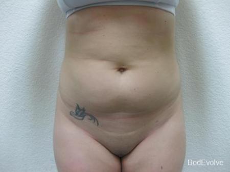 Liposuction - Patient 2 - Before
