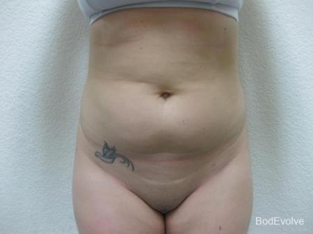 Liposuction - Patient 2 - Before Image 1