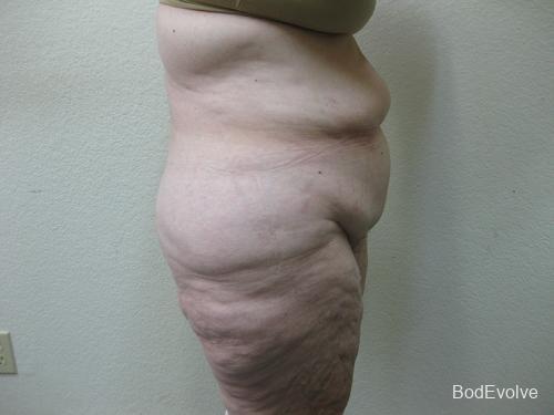 Patient 7 - Cosmetic Surgery After Massive Weight Loss - Before 6