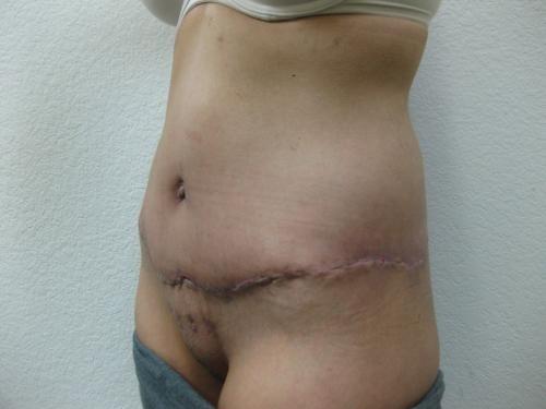 Patient 25 - Cosmetic Surgery After Massive Weight Loss -  After 2