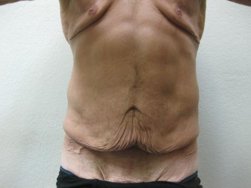 Body Lift - Patient 5 - Before 1