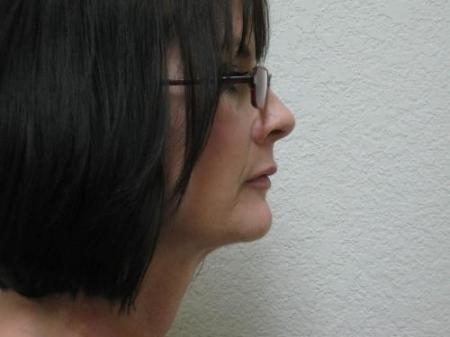 Lip Augmentation - Patient 2 - After Image 3