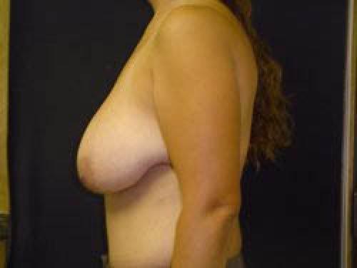 Breast Augmentation with Lift - Patient 9 - Before and After 3