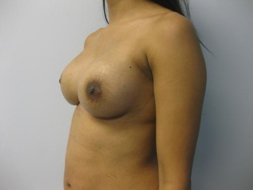 Breast Revision - Patient 2 -  After 2