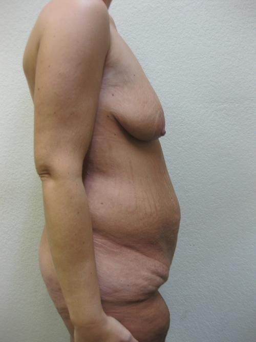 Cosmetic Surgery After Massive Weight Loss - Before 5