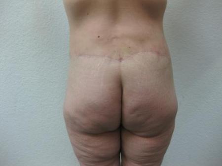 Body Lift - Patient 8 - After Image 3