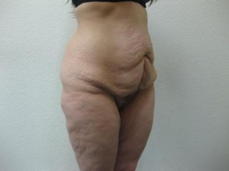 Body Lift - Patient 8 - Before Image 1