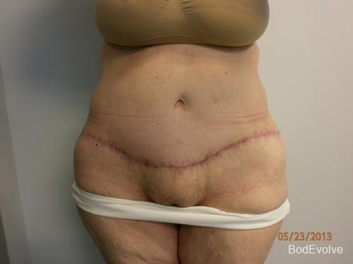 Patient 7 - Cosmetic Surgery After Massive Weight Loss -  After 1