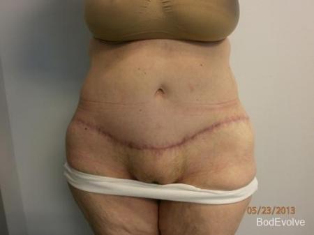 Patient 7 - Cosmetic Surgery After Massive Weight Loss - After 