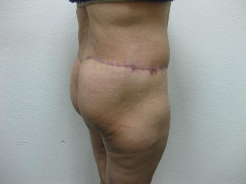 Patient 14 - Cosmetic Surgery After Massive Weight Loss -  After 3
