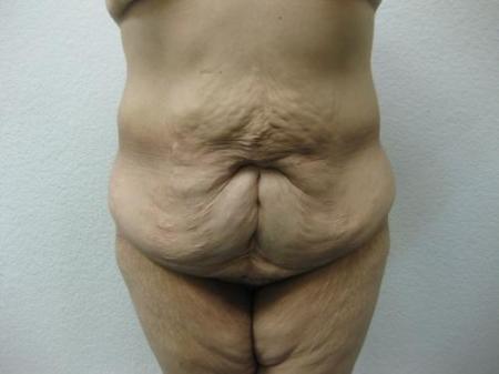 Body Lift - Patient 7 - Before Image 1