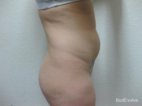 Liposuction - Patient 2 - Before and After 5