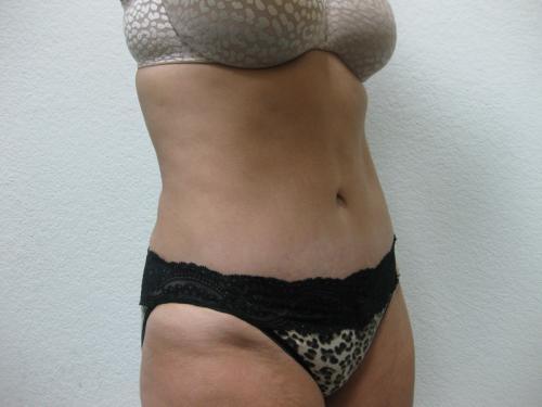 Tummy Tuck - Patient 4 -  After 5