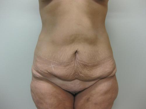 Patient 25 - Cosmetic Surgery After Massive Weight Loss - Before 1