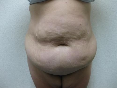 Patient 10 - Cosmetic Surgery After Massive Weight Loss - Before