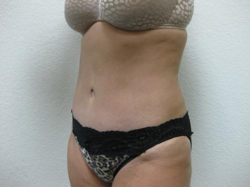 Tummy Tuck - Patient 4 -  After 3
